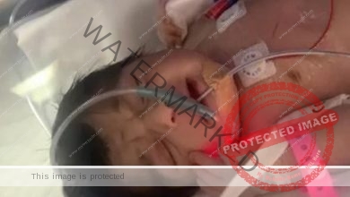 وفاة طفلة سعودية بعد رحلة علاج نتيجة قطعة معدنية داخل الفخذ