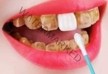 6 طرق طبيعية للتخلص من إصفرار الأسنان