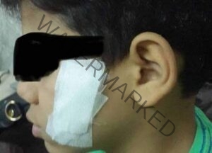 طالب في الصف الرابع الإبتدائي يشوه وجه زميله " بالموس في أجا" بسبب التختة الأولي