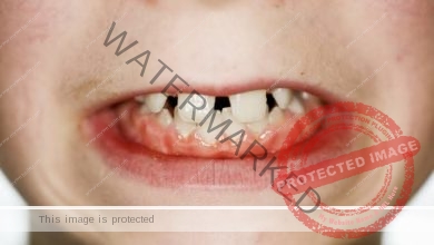 أسباب الفراغات بين الأسنان (diastema)... وكفية العلاج منها