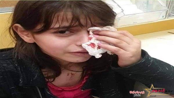 إصابة طفلة إثر انفجار صاروخ ألعاب نارية في عينها بالفيوم