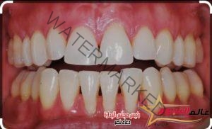 تعرف على (الجيوب اللثوية)... (Dental Pockets)