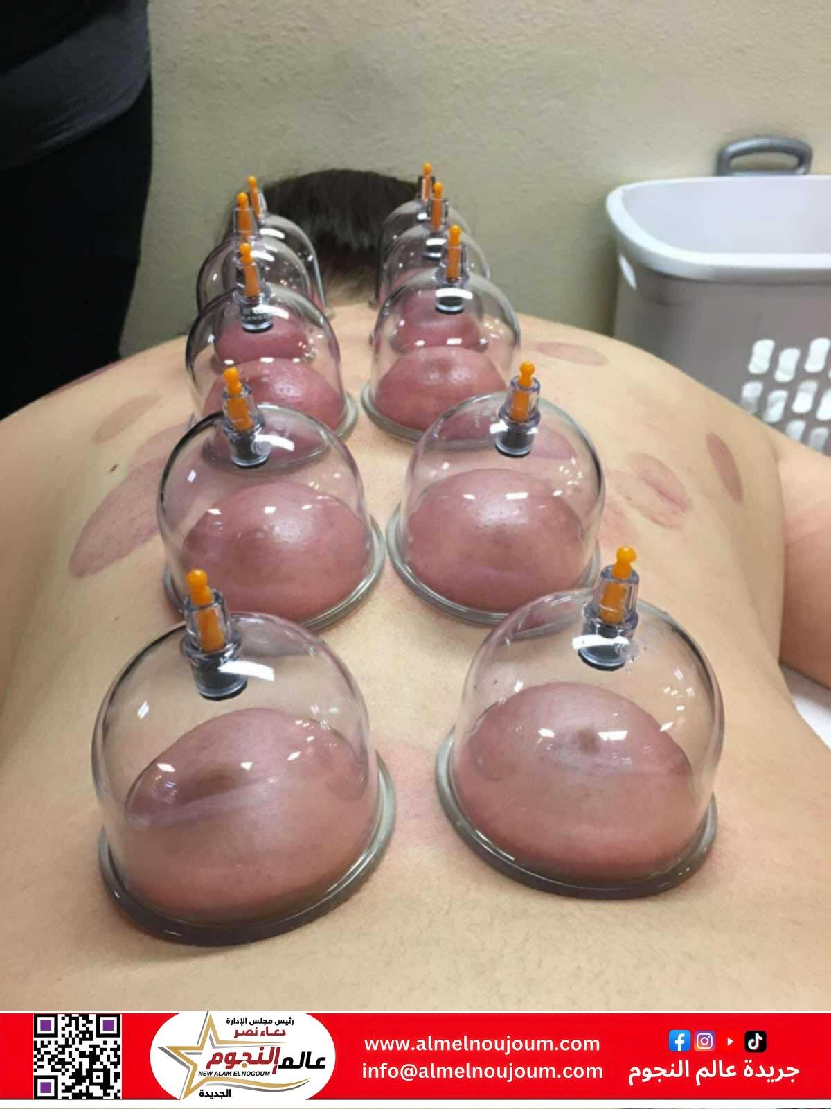 فوائد كاسات الهواء (الحجامة الجافة).. بين الطب التقليدي والعلاج الوقائي