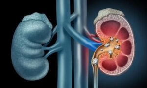 حصوات الكلى علامات مبكره وطرق الوقاية والعلاج