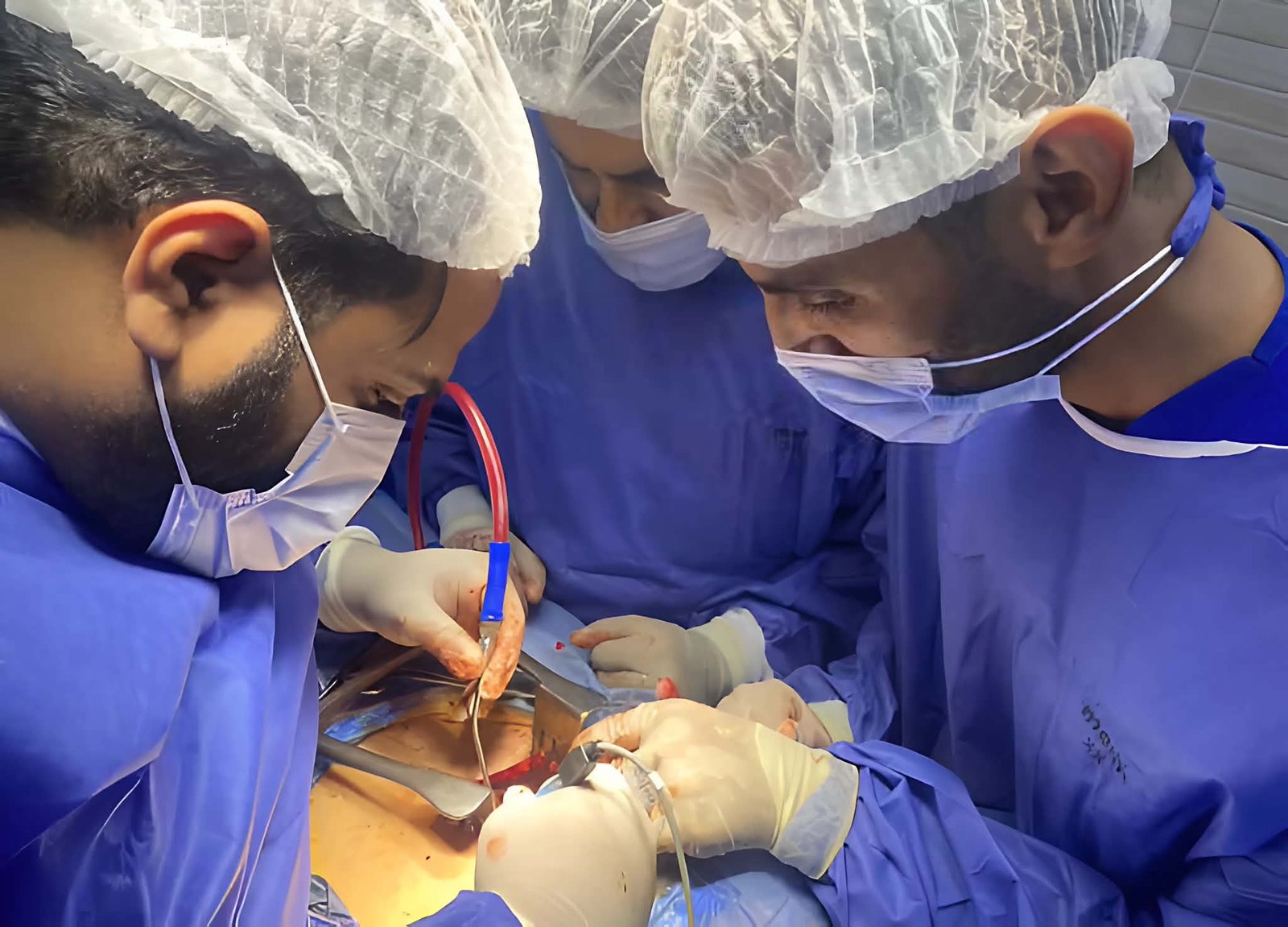 إنجاز طبي بجامعة الزقازيق.. استئصال ورم ضخم من صدر طفلة عمرها 6 سنوات