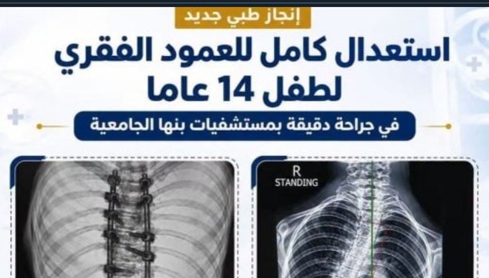 إنجاز طبي عاجل.. استعدال كامل للعمود الفقري لطفل 14 عامًا بمستشفيات جامعة بنها 3 إنجاز طبي عاجل.. استعدال كامل للعمود الفقري لطفل 14 عامًا بمستشفيات جامعة بنها