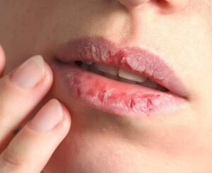 جفاف البشرة في الشتاء.. لماذا تشعرين بشد الوجه وتشقق الشفاه وكيف تحمين بشرتك؟